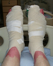 Big Toenails Removed - Bandaged Feet