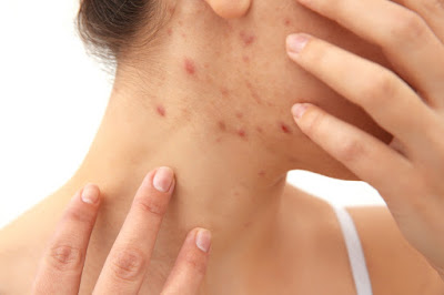 How to remove acne from your face