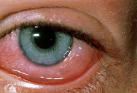Red Eye Symptoms
