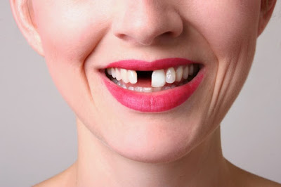 Dấu hiệu bạn mắc bệnh răng miệng nguy hiểm - Răng sứt mẻ
