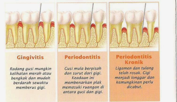 AKU DIA DAN LAGU: braces ~ part II ~ penyakit gusi