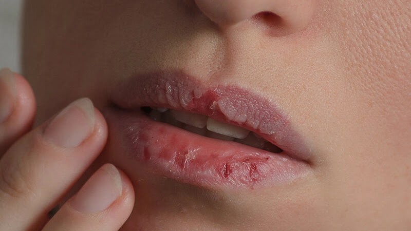 If your lips are chapped in winter, try this homemade recipe.
