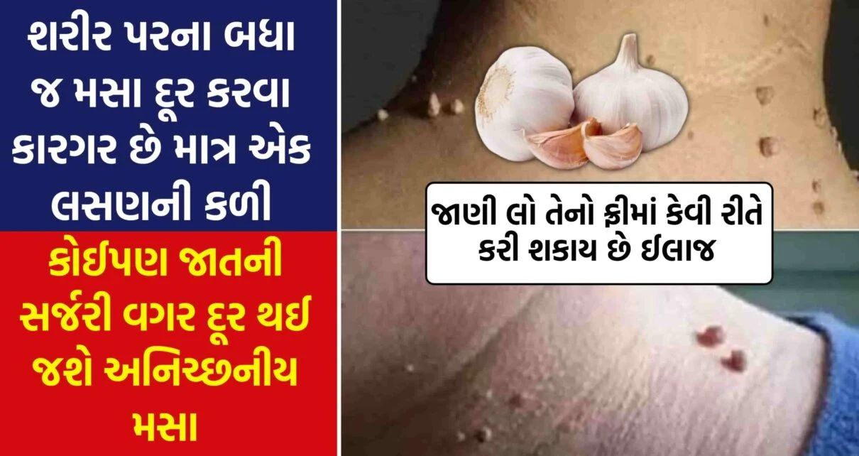 Get rid of warts on the body without any kind of surgery, know how it can be cured for free.