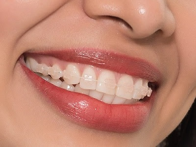 Niềng răng mắc cài sứ có ưu điểm gì?