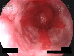 barret's-esophagus-image-reload