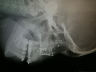 Temporamandibular TMJD jaw pain