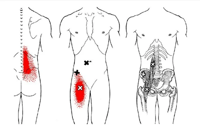 lumbalgia y ciática - cuadrado lumbar - psoas - mc spa