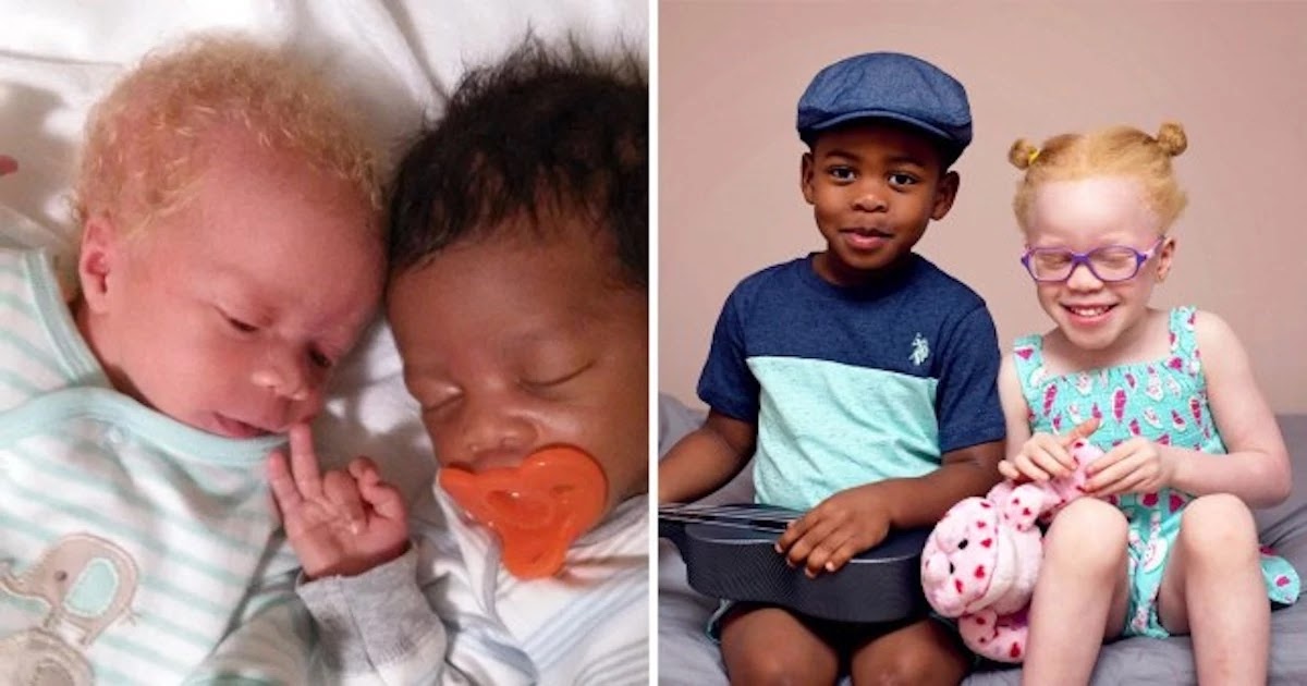 These Beautiful Twins Were Born Different Colours, To The Absolute Surprise Of Their Mother