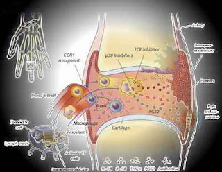 Askep -<a href='http://www.kapukonline.com/'> Asuhan Keperawatan</a> Rheumatoid Arthritis