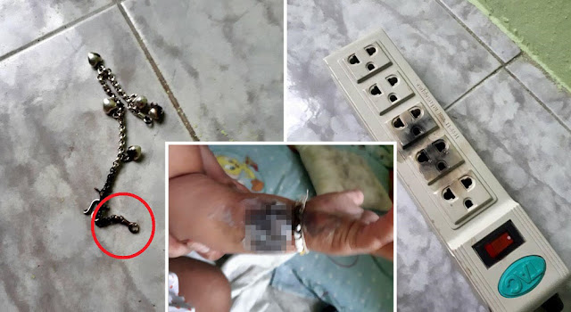 Bayi Melecur Teruk Ditangan, Kalung Gelang Tangan Dipakainya Termasuk Dalam Lubang Soket Elektrik Ketika Merangkak