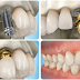 Trồng răng implant cần lưu ý những gì?