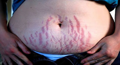 Stretch Marks