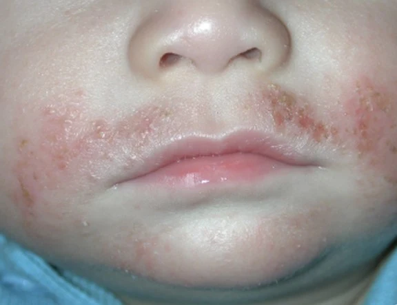 Caring For Eczema