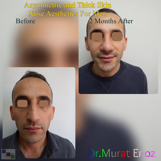 Rhinoplasty for male in Istanbul - Men's nose aesthetic in Turkey - Male rhinoplasty