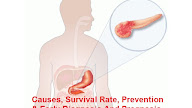 Pancreatic Cancer : Causes, Survival Rate, Prevention And Early Diagnosis And Prognosis