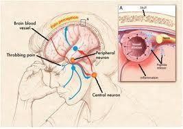 Migraine Headaches Problems 