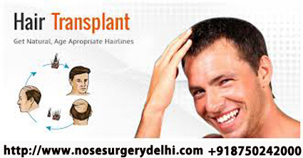 hair transplant in delhi