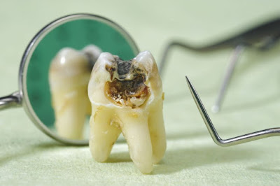 Thông tin nhổ răng cấm bị sâu có đau không tới khách hàng-2