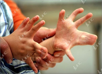 boy with 31 fingers and toes