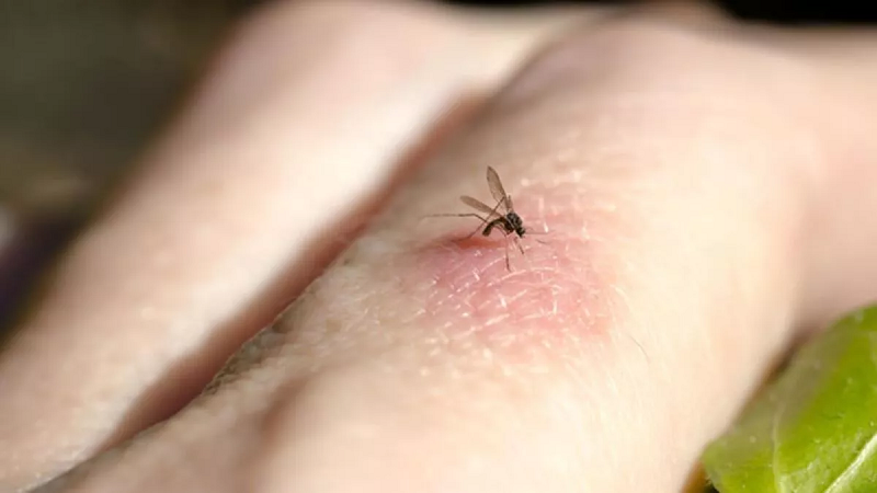Sivrisinek ısırığı alerjisi nedir? Sivrisinek ısırığına ne iyi gelir?