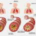 Penyebab Gejala Penyakit Asma