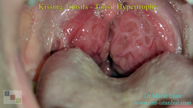 Kissing Tonsils - Tonsil Hypertrophy