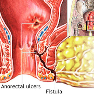 Fistula Treatment In Thane West 