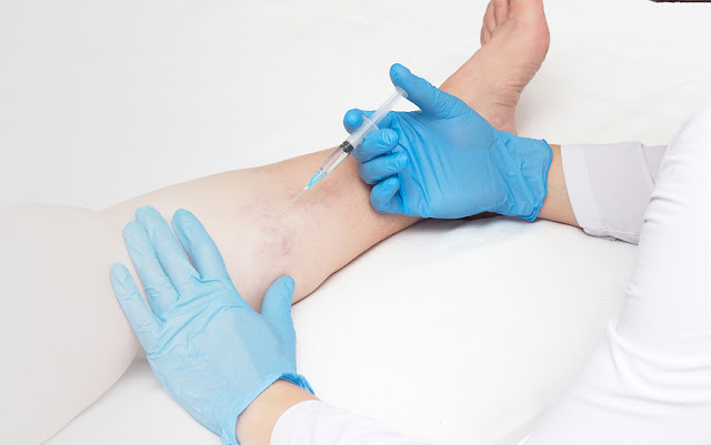 Microsclerotherapy Treatment