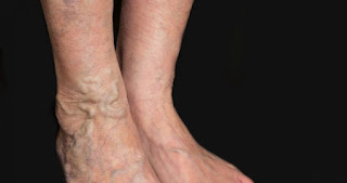 varicose vein