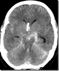 MOHAMMAD_RASEL_43_M.CT.NCCT_BRAIN.2.9.2011.03.25.15.19.02.312500.17553508