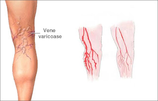 Varice: terapii alopate, fitoterapie, masuri de prevenire