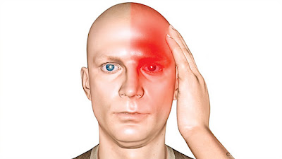 Cluster headaches : causes, symptoms and treatment