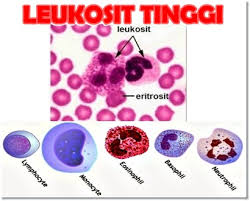 Obat Penurun Leukosit Tinggi