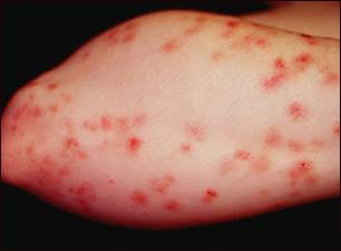 Dermatitis Herpetiformis