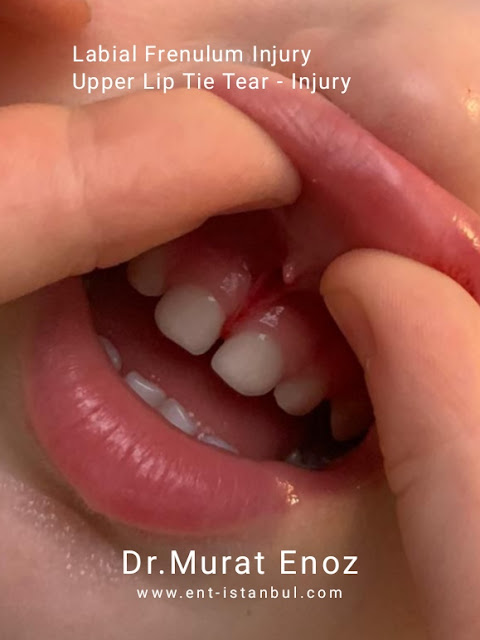 Labial Frenulum Injury upper lip tie tear