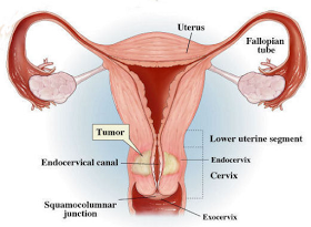 Cervical cancer 