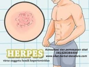 obat herpes kelamin,obat herpes zoster,obat cacar dompo,obat cacar air,obat herpes kemaluan,obat herpes tangan,obat herpes bibir,obat herpes badan