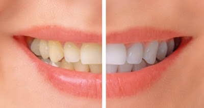 Teeth Whitening