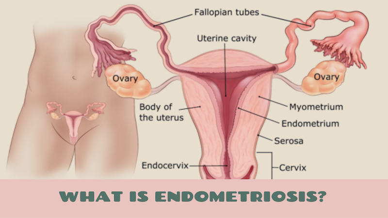 What Is Endometriosis?