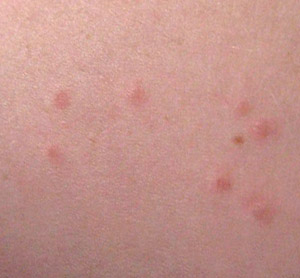 What Do Bed Bug Bites Look Like: May 2011