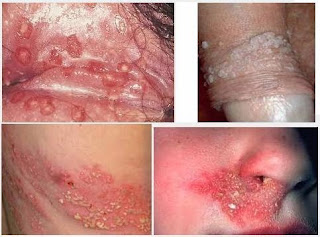 Berapa Harga Obat Herpes Gangjie Ghosiah Di Bangka Selatan Mentok Kepulauan Bangka Belitung