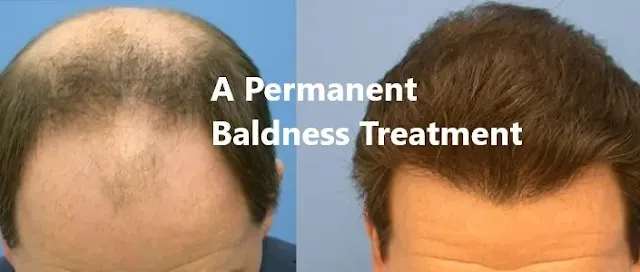 A Permanent Solution to Baldness: A Comprehensive Guide to A Permanent Baldness Treatment