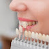 Thông tin về bọc răng sứ