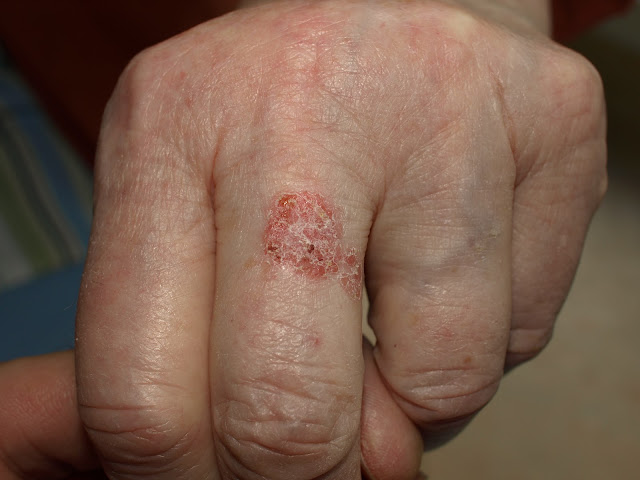 Figure 4: Non-melanoma skin cancer can masquerade as a rash that does not heal