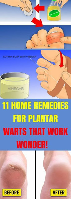 11 HOME REMEDIES FOR PLANTAR WARTS THAT WORK WONDER!