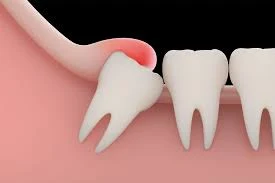 widom-teeth-removal