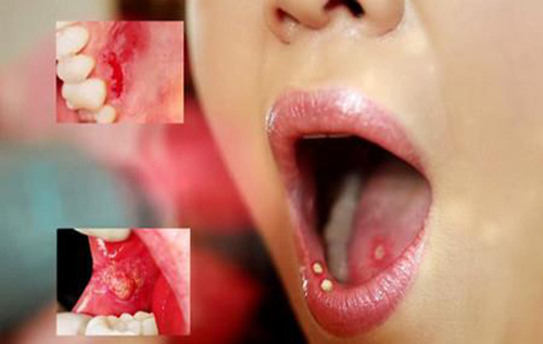 Bị bệnh lậu ở miệng do quan hệ bằng miệng