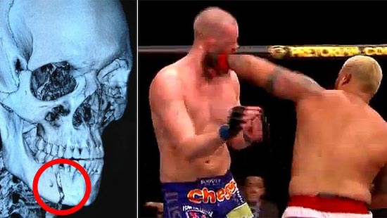 10 Cedera MMA paling Parah & Mengerikan yang Pernah Ada