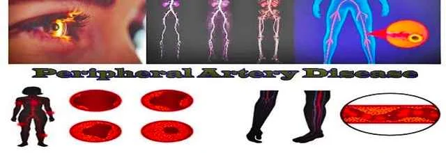 Illustration depicting peripheral artery disease affecting the lower limbs and body