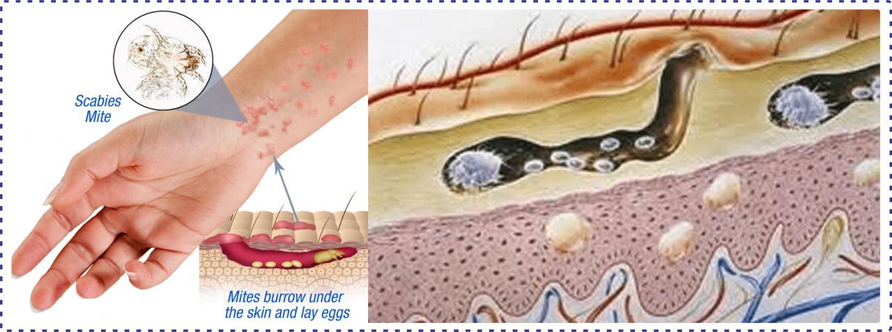 PENGALAMAN TERSERANG PENYAKIT SKABIES DAN CARA 